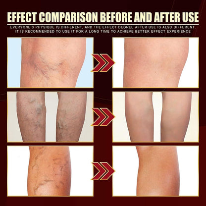 VEIN HEALING VARICOSE VEINS TREATMENT SPRAY - Buy 1 Get 1 FREE