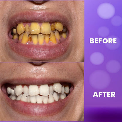 Purple Teeth Whitening Gel