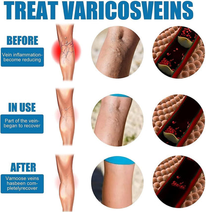 VEIN HEALING VARICOSE VEINS TREATMENT SPRAY - Buy 1 Get 1 FREE